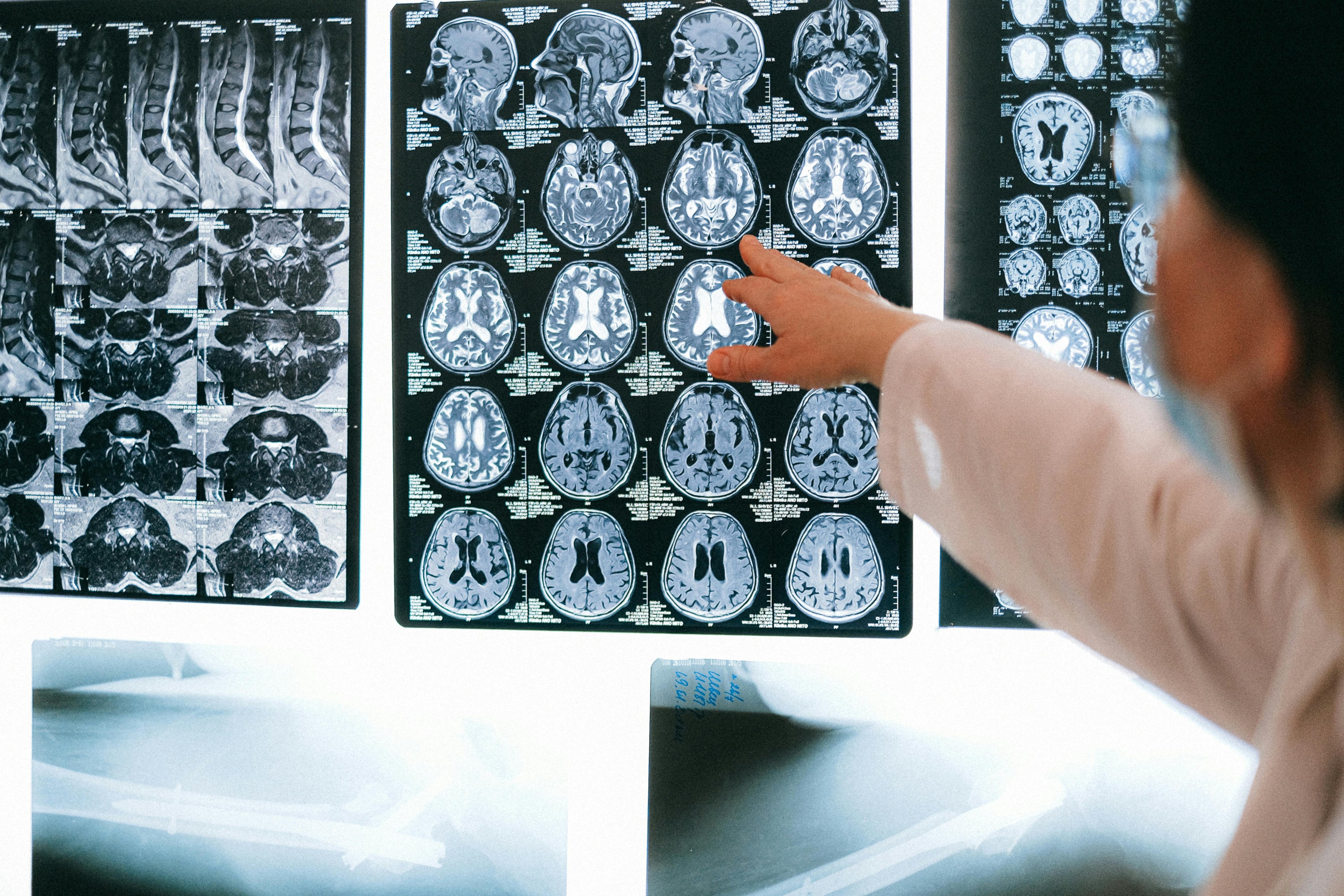 Medical professional reviewing x-ray images of a brain 